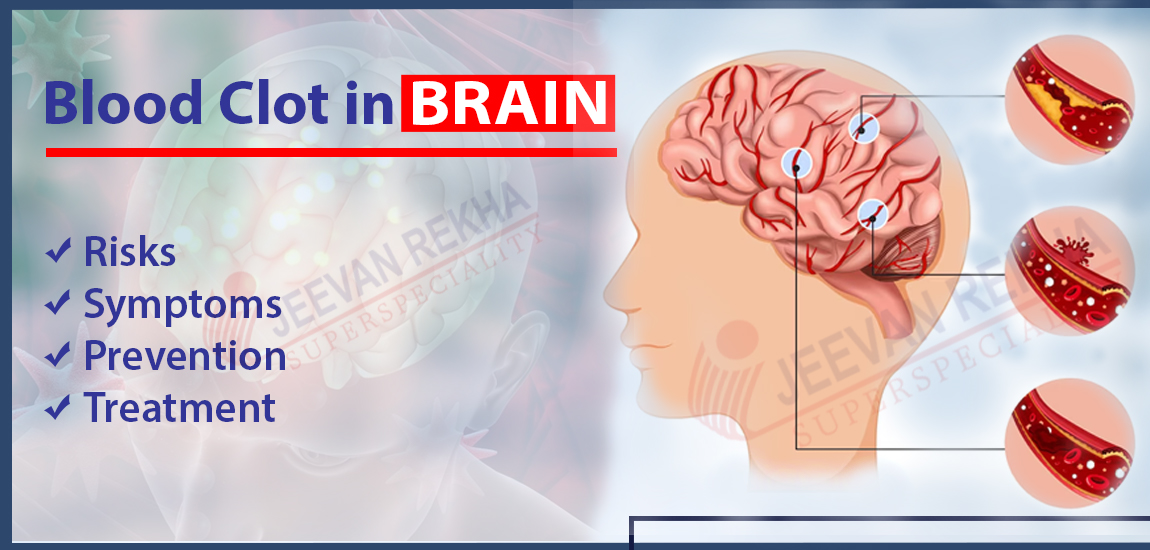 Blood Clot in Brain: Risks, Symptoms, Prevention & Treatment